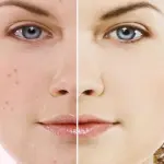 L'Acne: Cause e cura