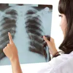 La frattura delle costole